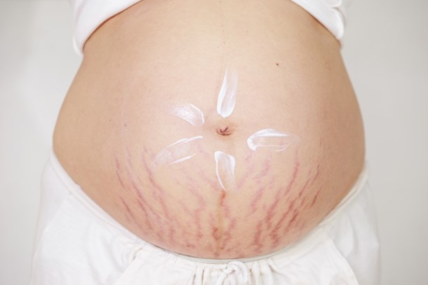 5 Formas de prevenir las estrías durante el embarazo